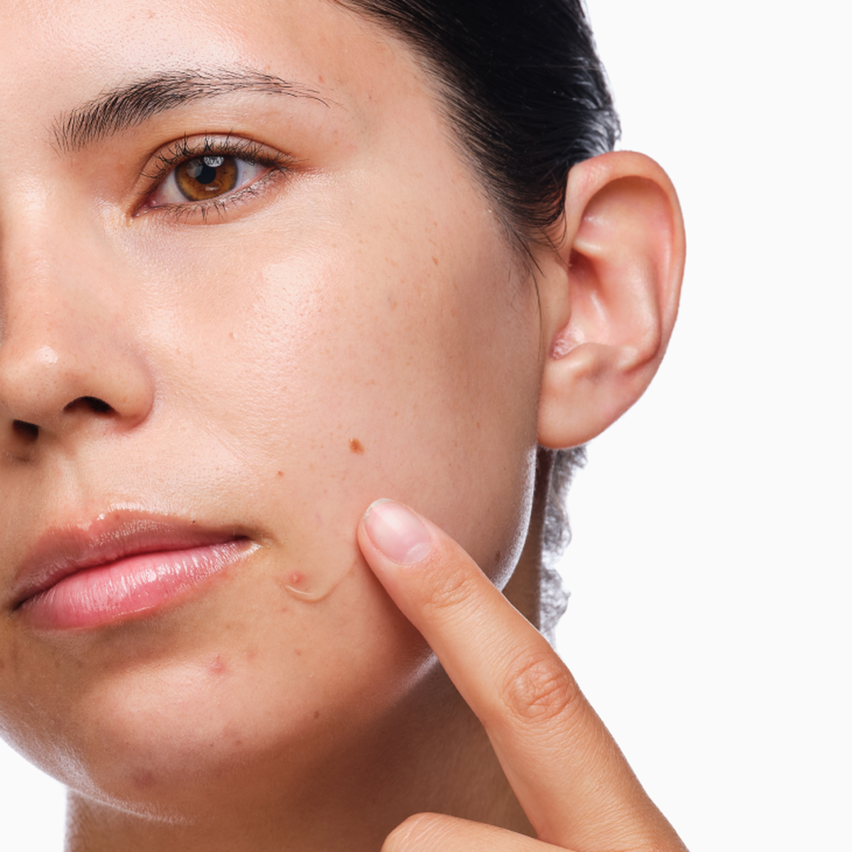 the-acne-set-a4 rdn-the-acne-set-application.png