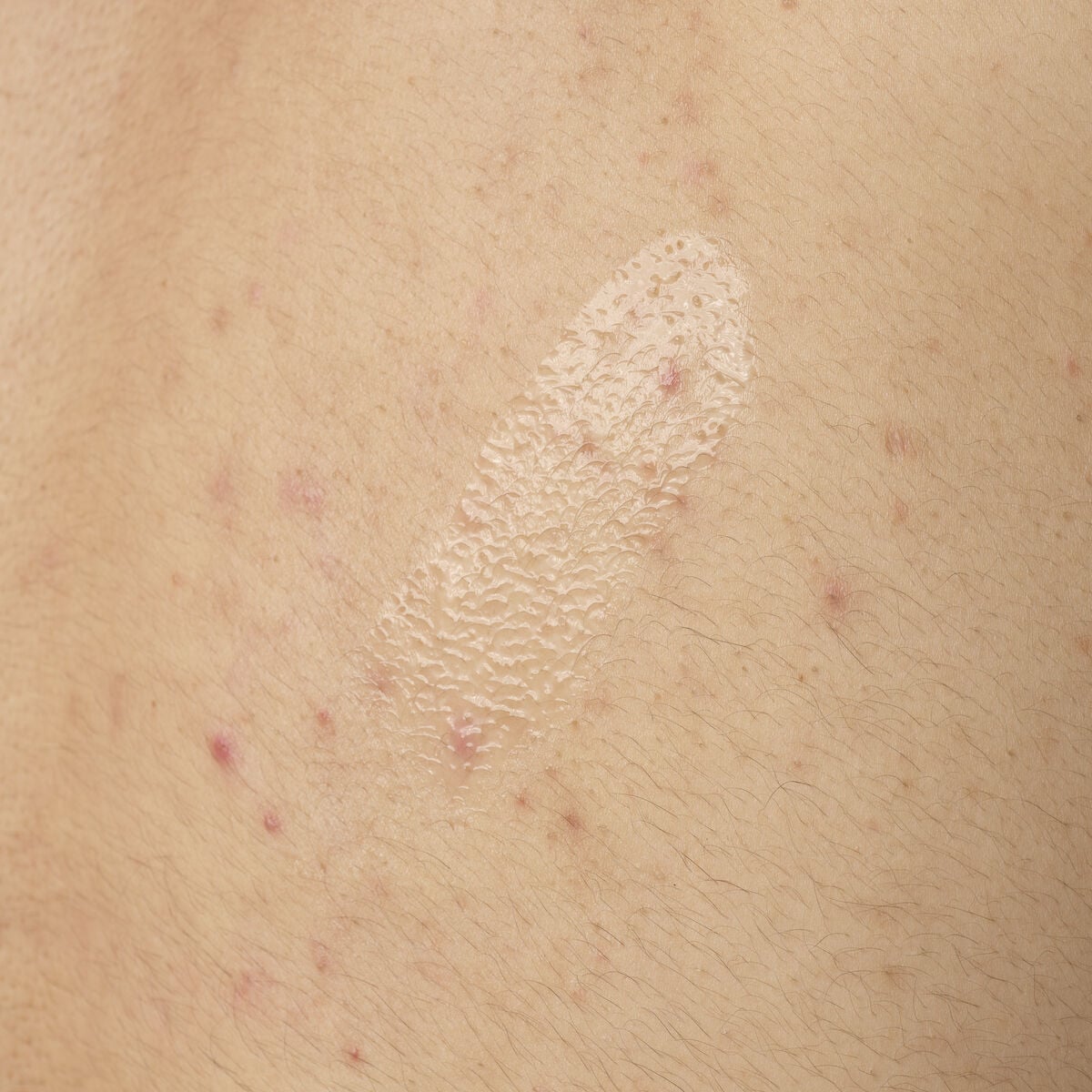 salicylic-acid-0-5-body-serum-l6 ORD-salicylic-acid-05-body-240ml-application.jpg