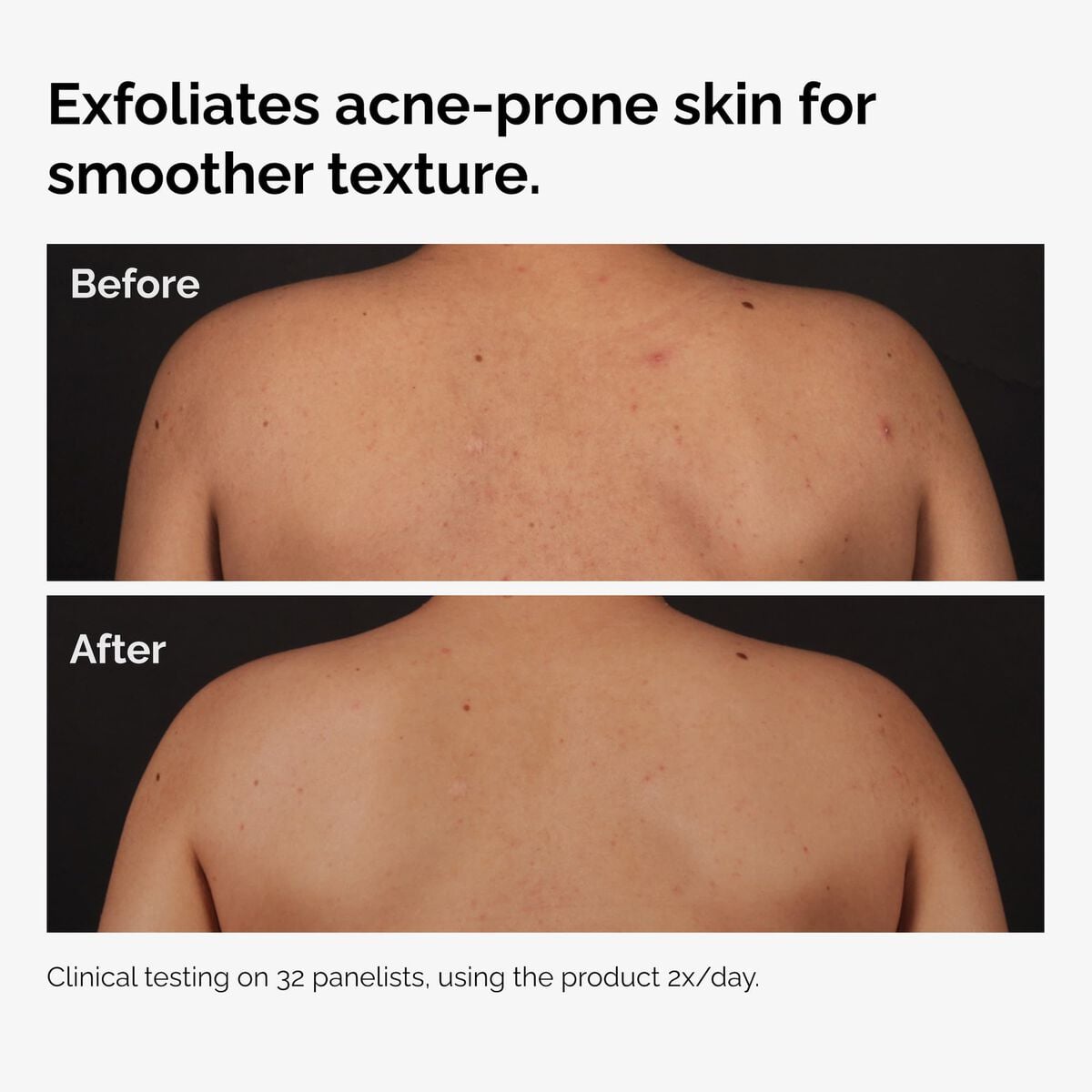 salicylic-acid-0-5-body-serum-l6 ord-salicylic-acid-body-serum-before-after-graphic-NA.jpg